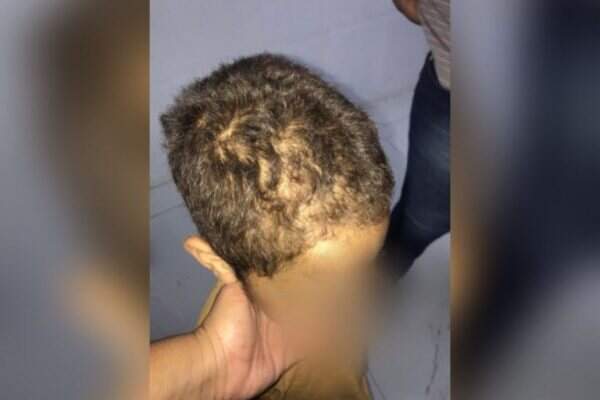 Criança tinha vários hematomas no corpo