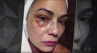 Luiza Brunet em foto feita após agressão (Reprodução TV Globo/Fantástico)