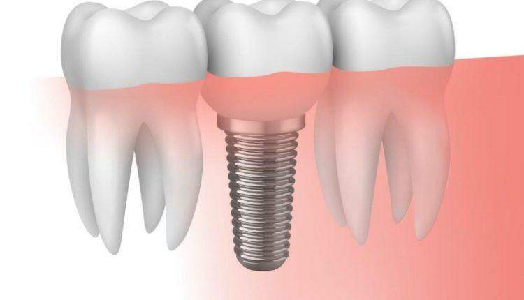 Tratamentos com implantes dentários finalizados  em 28 dias? Sim, agora é possível