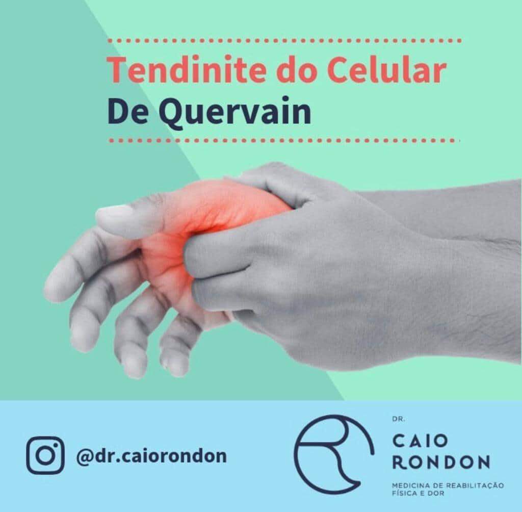 Dr.Caio Rondon fala sobre Tenossinovite de De Quervain.