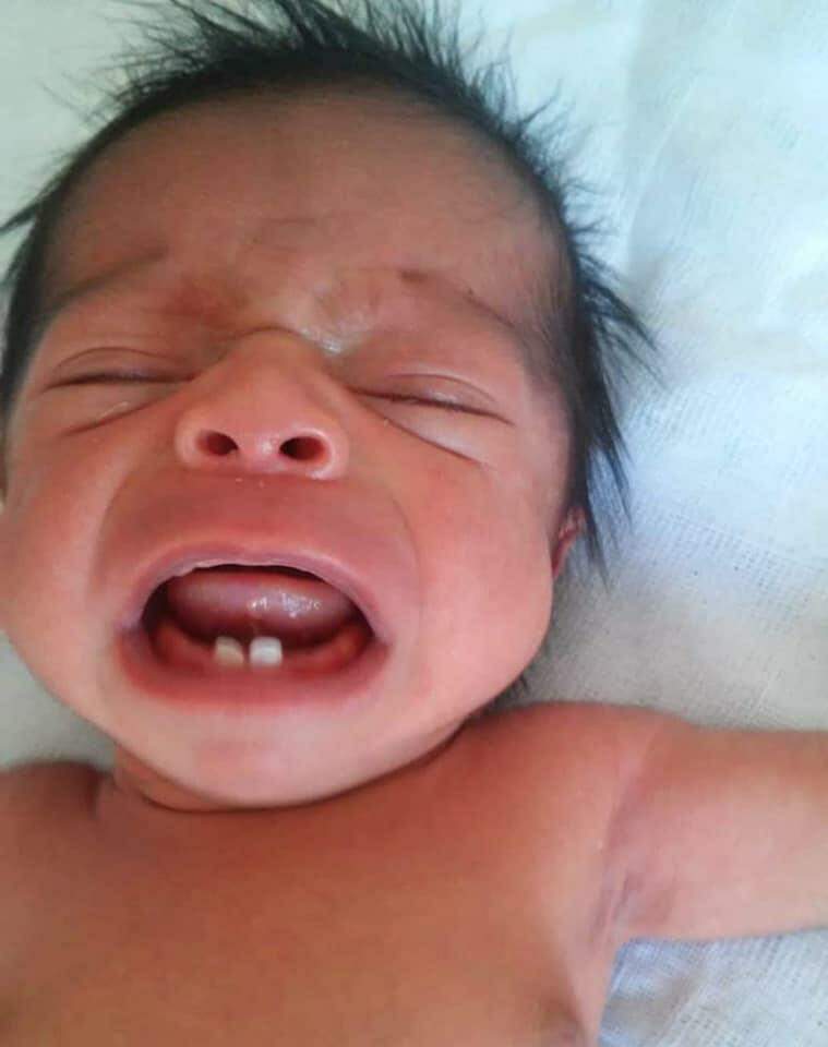 Bebê nasce com dois dentes em Sorocaba, SP.