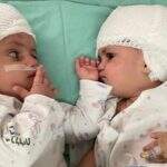 Gêmeos unidos pela cabeça separados após uma rara cirurgia em Israel