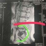 “Dor e choro”: mulher com doença grave na coluna busca ajuda para cirurgia
