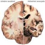 Pesquisa revela que vírus causador da herpes pode provocar danos cerebrais que levam ao Alzheimer