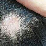 1 em 4 pessoas tem queda de cabelo após Covid; veja como amenizar condição