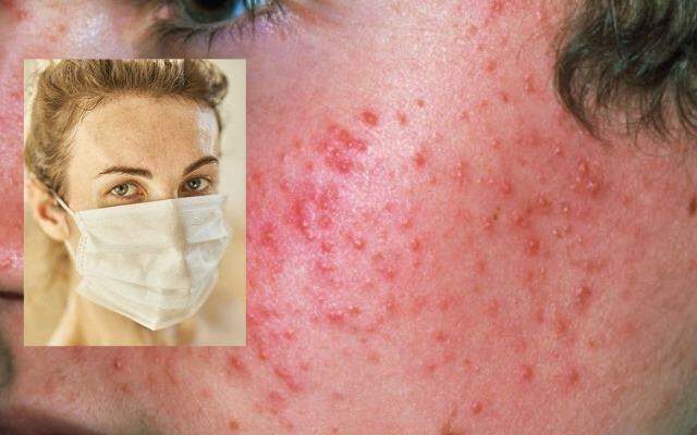 Máscara e calor de MS podem causar acne; Confira como evitar o problema