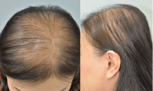 O tratamento regula o ciclo de crescimento capilar: o paciente vai observar cabelos crescendo e