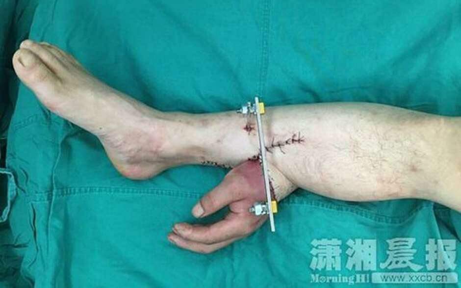 Homem tem mão decepada e médicos a enxertam no tornozelo