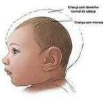 Casos de microcefalia atingem 1.434 no país e MS mantém 2 registros
