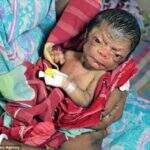 Bebê ‘Benjamin Button’ nasce com pelos, rugas e cara de idoso em Bangladesh