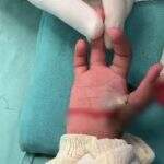 Santa Casa realiza primeira cirurgia de MS que transforma dedo indicador em polegar