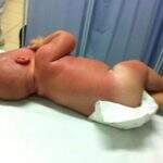 Bebê de 5 meses sofre graves queimaduras após exposição ao sol