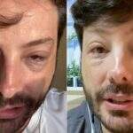Danilo Gentilli sofre reação alérgica durante Páscoa e mostra estado do rosto nas redes sociais