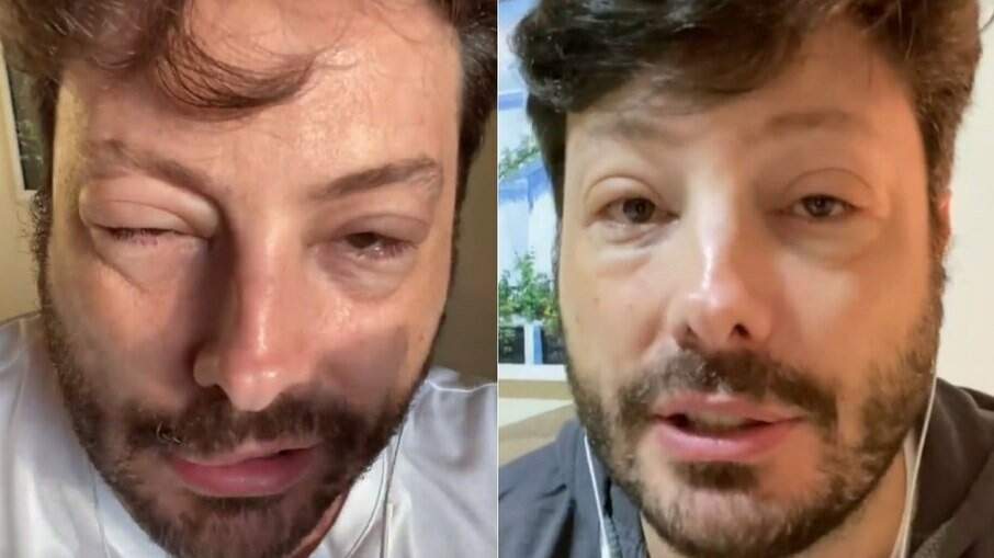 Danilo Gentilli sofre reação alérgica durante Páscoa e mostra estado do rosto nas redes sociais