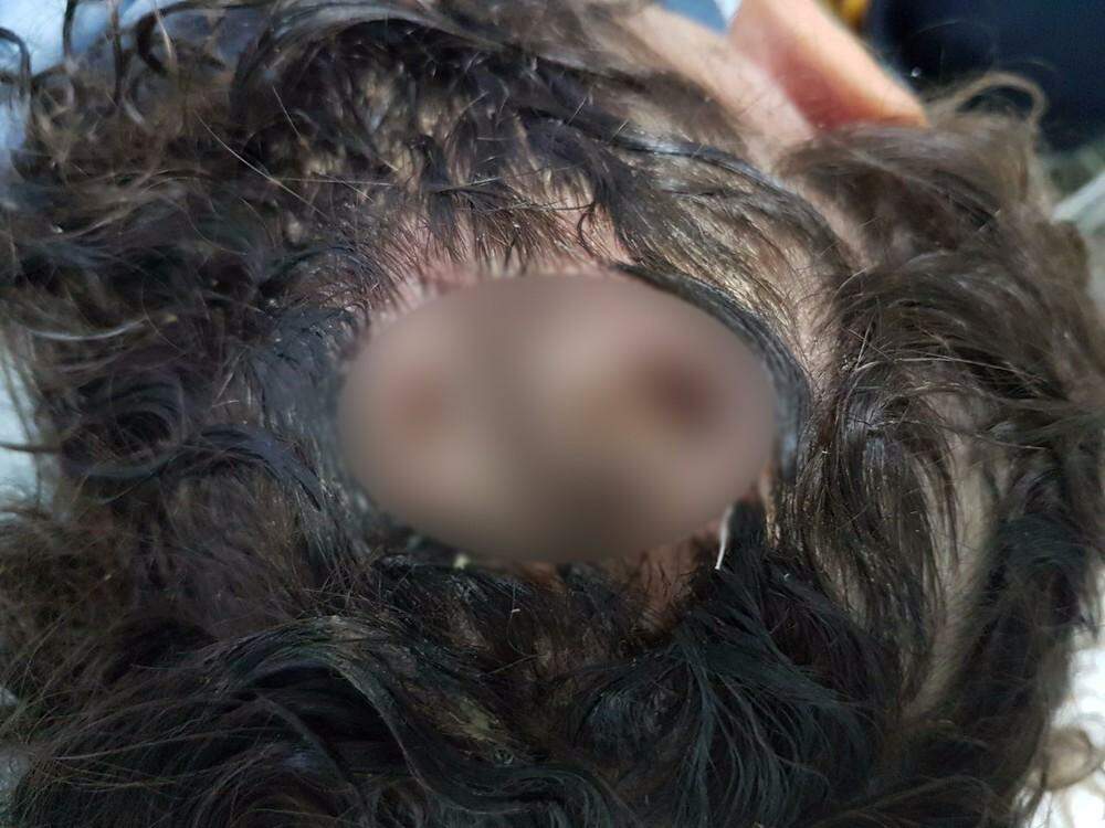Criança é internada em hospital do Recife com infestação de larvas de mosca na cabeça