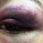 Polícia vê mulher ensanguentada e prende marido em flagrante após chutes no rosto