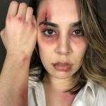 Naiara Azevedo publica foto com machucados e olho roxo no Instagram