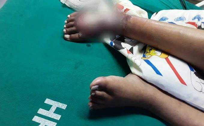 HRMS não esclarece queimadura de paciente e família insiste que rapaz foi esquecido em exame