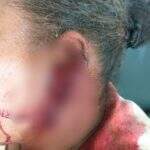 Mulher que teve orelha cortada por marido recebe alta de hospital