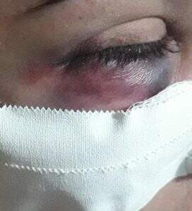 Mulher ficou com ferimento no olho após agressão. Foto: Divulgação