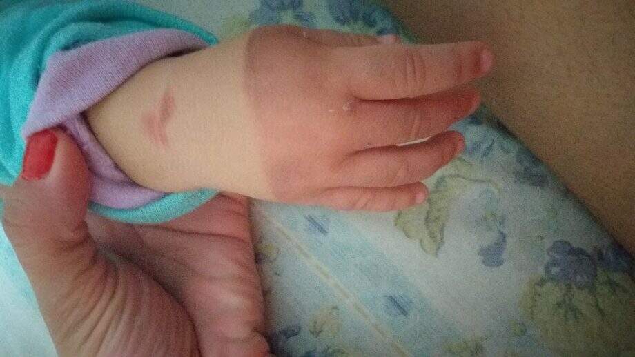 Mão da criança que sofreu a queimadura (reprodução)