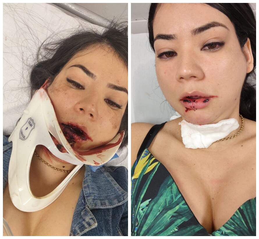 Esteticista quebra dentes em acidente e amigos promovem almoço para custear implante