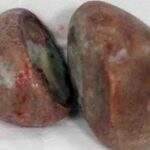 Médicos retiram duas pedras gigantes de dentro da vagina de mulher na Indonésia