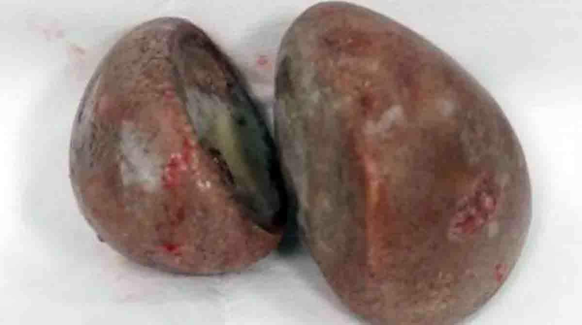 Médicos retiram duas pedras gigantes de dentro da vagina de mulher na Indonésia