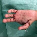 Com 4 dedos, menino ganha novo polegar após transplante do indicador na Santa Casa de Campo Grande