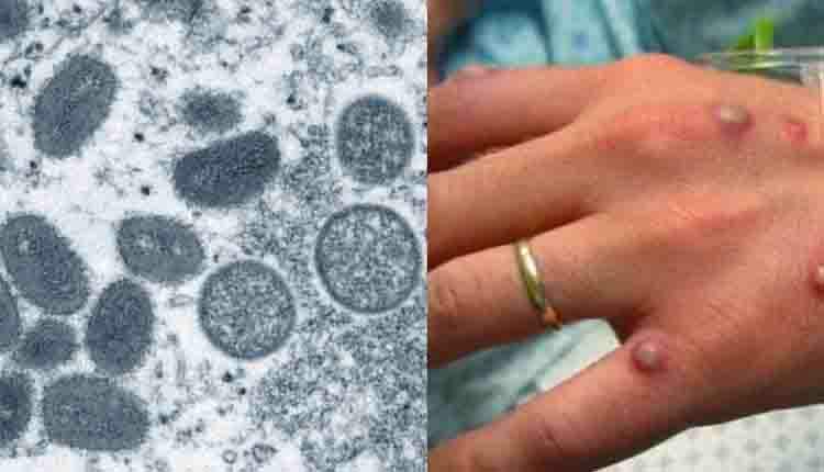 Laudo que vai determinar se adolescente é 1º caso de varíola dos macacos em MS fica pronto em 20 dias