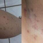 Mulher processa clínica de estética após sofrer queimaduras durante depilação a laser em Campo Grande