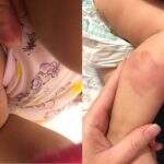Mãe denuncia creche particular após filha de 9 meses aparecer com hematomas pelo corpo
