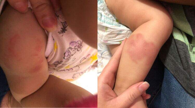 Mãe denuncia creche particular após filha de 9 meses aparecer com hematomas pelo corpo