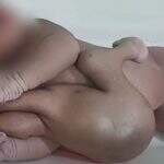 Bebê nasce com quatro braços e quatro pernas é tratado como divindade na Índia