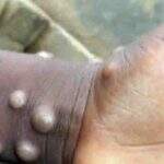 Campo-grandense com varíola dos macacos é tratado em casa e já não transmite a doença