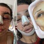 Feminilização facial: Linn da Quebrada passa por cirurgia para deixar o rosto mais feminino