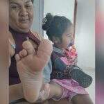 Macrodatilia: mãe descobre doença de menina de 3 anos e diz que ela precisará amputar dedo