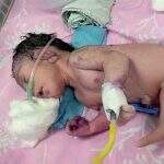 Nascimento de ‘bebê-sereia’ choca médicos e atrai multidão a maternidade na Índia