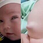 ‘Ele chora de dor’: com hérnias, bebê de 5 meses aguarda por cirurgia em Campo Grande