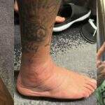 Veja como ficou o tornozelo de Neymar após lesão durante jogo da Copa do Catar