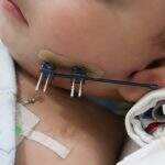 Santa Casa opera segundo caso raro de distração osteogênica mandibular em bebê
