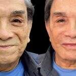 Dedé Santana passa por harmonização facial aos 86 anos e choca: ‘carinha de…’