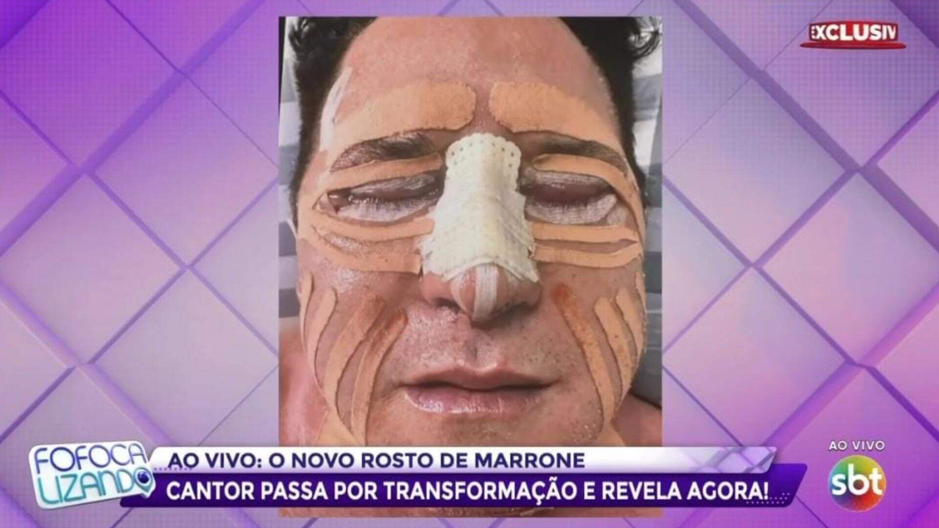 VÍDEO: Após mudar de rosto com cirurgias, Marrone mostra o resultado pela primeira vez
