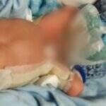 Família pede investigação da PF após bebê sofrer queimaduras em incubadora do HU de Dourados