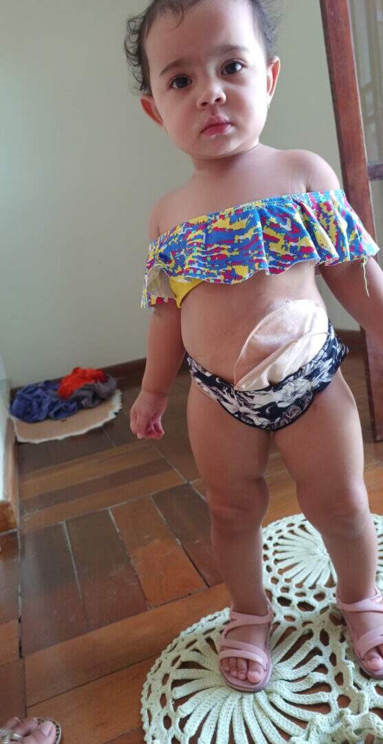 Maria Clara sofre com bolsa de colostomia - (Foto: Arquivo Pessoal)