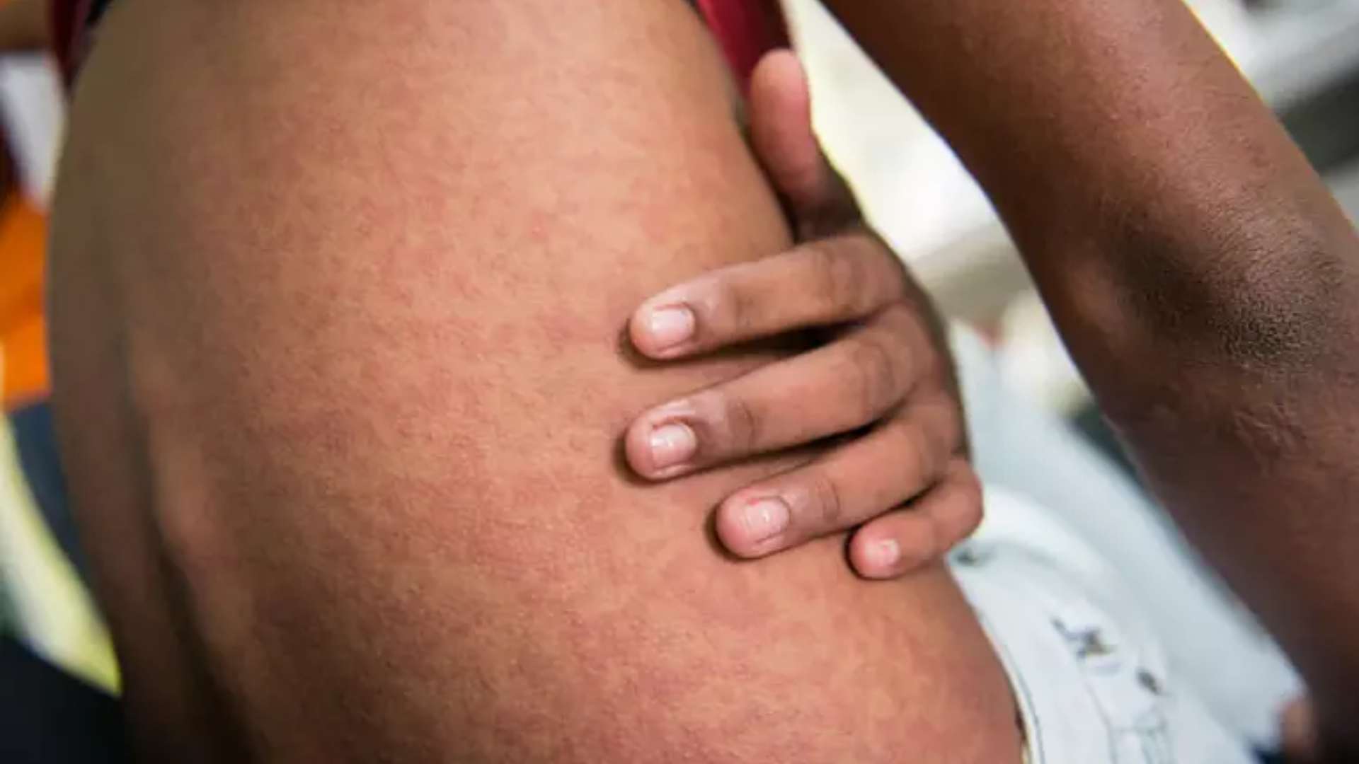 Com epidemia no Paraguai, MS vive alta de chikungunya com 900 casos e três mortes em 2023